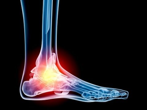 3D Printing Helps in Ankle Replacement Surgery
